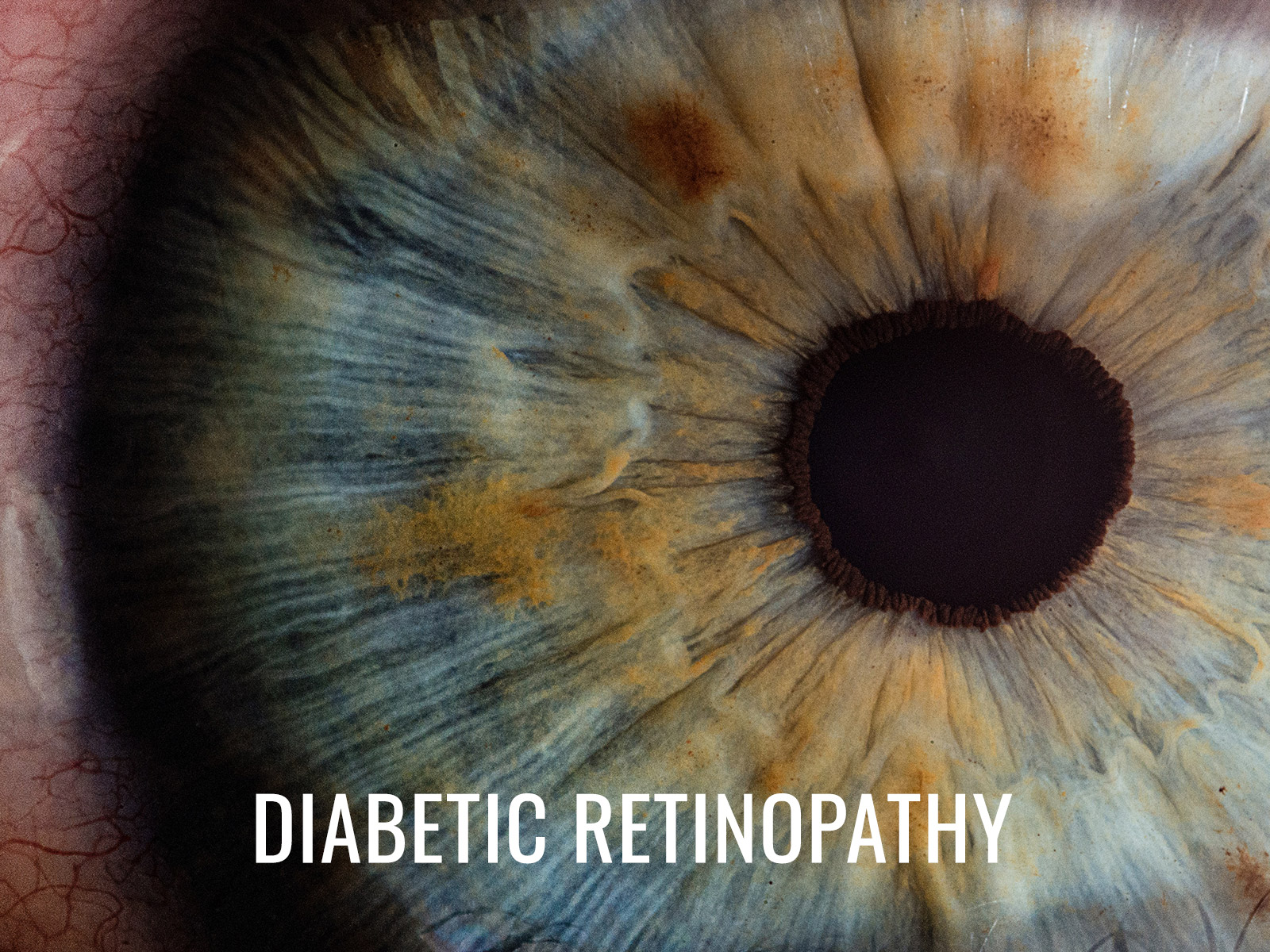 Divya Eye Clinic diabetic-retinopathy